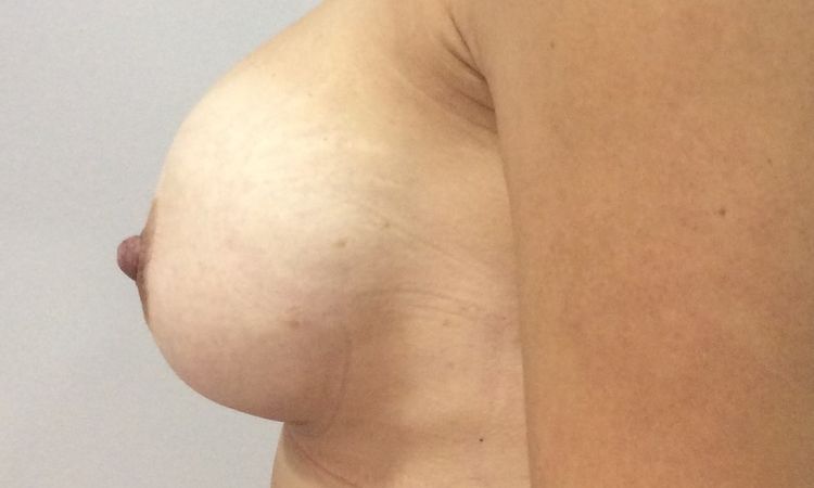Pezones asimétricos tras segunda intervención con mastopexia periareolar - 53416