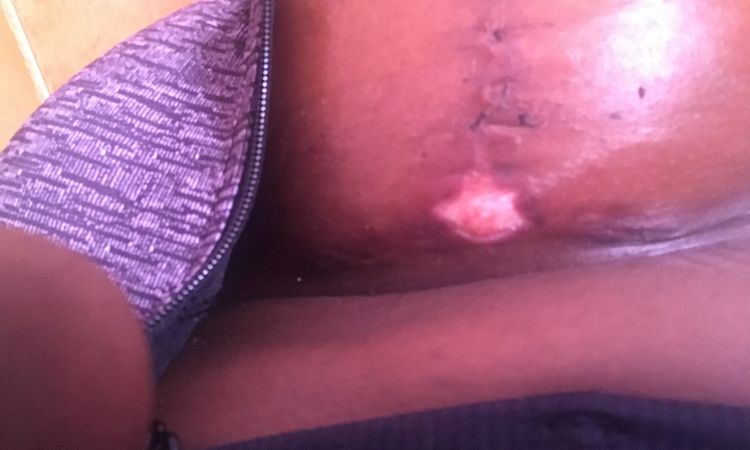 Puntos infectados y sutura abierta tras 1 mes mastopexia - 53551