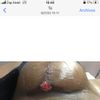 Puntos infectados y sutura abierta tras 1 mes mastopexia