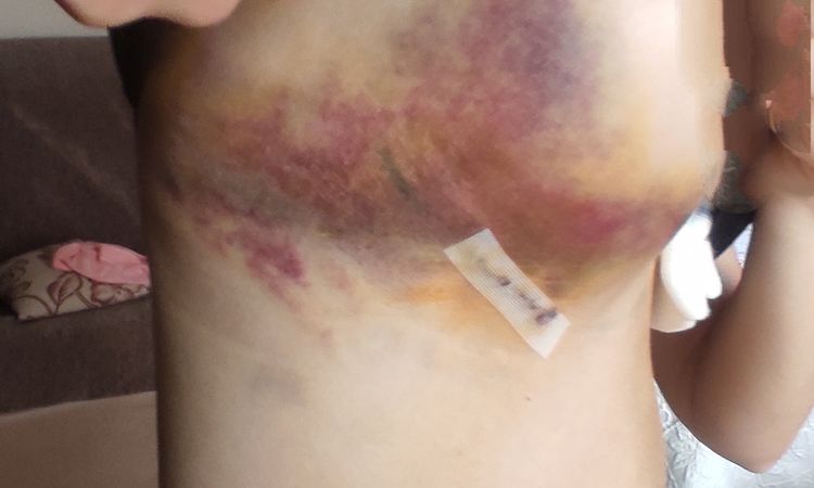 Hematomas por todo el pecho después de un aumento - 53572