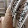 Aparición de irregularidades en la piel tras 6 meses liposucción