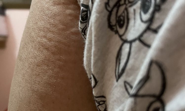 Aparición de irregularidades en la piel tras 6 meses liposucción - 53705