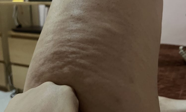 Aparición de irregularidades en la piel tras 6 meses liposucción - 53706