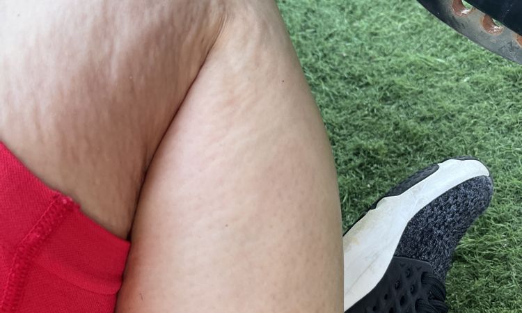 Aparición de irregularidades en la piel tras 6 meses liposucción - 53707
