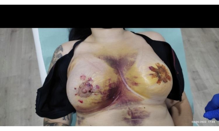 Gran inflamación y hematoma tras Mastopexia periareolar - 54026