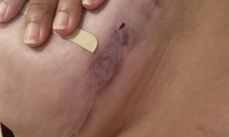 Sangrado tras 4 meses de mastopexia ¿posible rechazo? - 54068