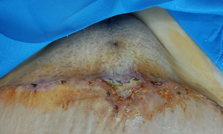 Bulto después de abdominoplastia tras úlcera de presión - 54071