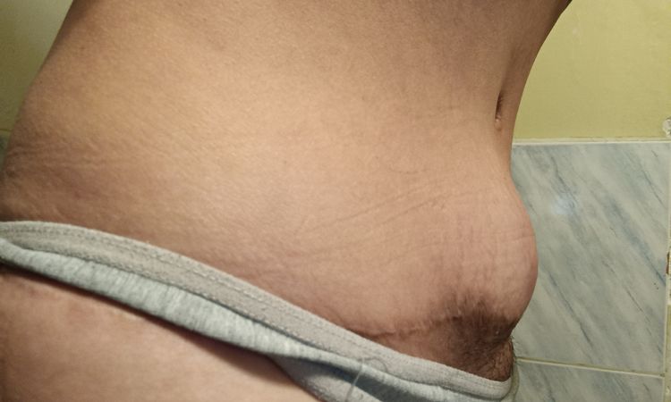 Bulto después de abdominoplastia tras úlcera de presión - 54072