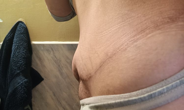 Bulto después de abdominoplastia tras úlcera de presión - 54073