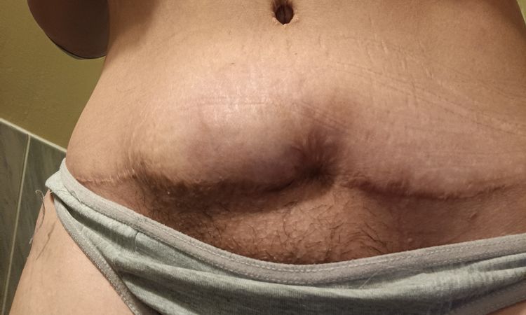 Bulto después de abdominoplastia tras úlcera de presión - 54074