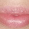 Puntos oscuros en labio superior tras infiltración de ácido hialurónico