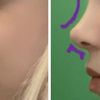 Desproyección de la punta de la nariz con rinoplastia cerrada