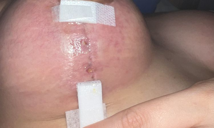 Posible infección tras mastopexia - 54160
