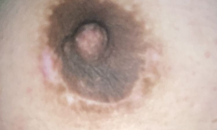 Solución a cicatriz hipertrófica en areola - 54190