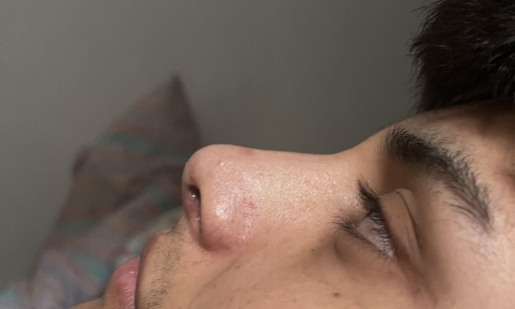 A un mes de la rinoplastia la punta de la nariz cambia? - 54251