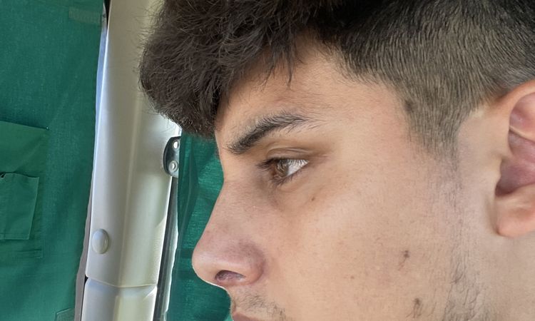 A un mes de la rinoplastia la punta de la nariz cambia? - 54254