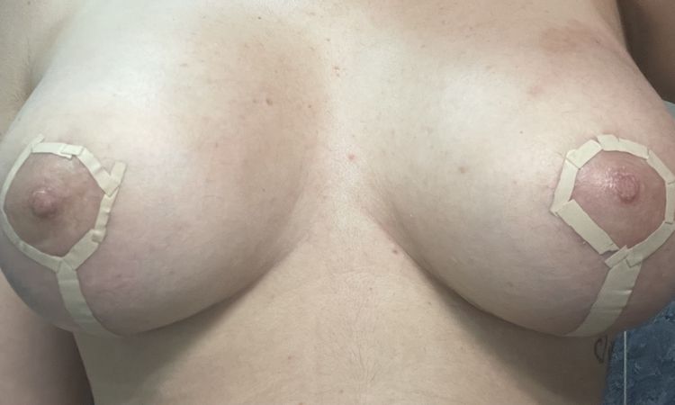 Pecho caído tras Mastopexia con prótesis hace 2 meses y medio - 54257