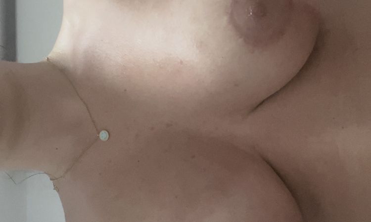 Pecho caído tras Mastopexia con prótesis hace 2 meses y medio - 54261
