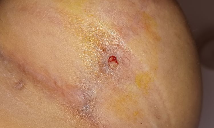Punto de mastopexia se vuelve a abrir a los 2 meses - 54328