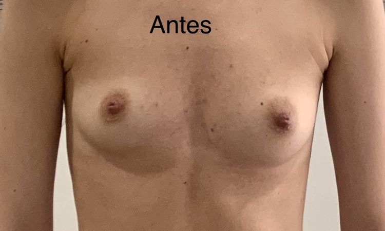 Hematoma a los 14 días de la operación de pecho de aumento - 54421