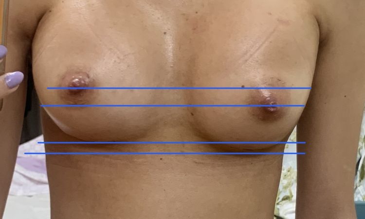 Hematoma a los 14 días de la operación de pecho de aumento - 54423