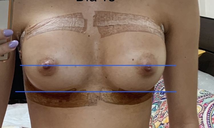 Hematoma a los 14 días de la operación de pecho de aumento - 54424