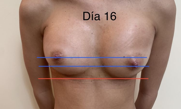 Hematoma a los 14 días de la operación de pecho de aumento - 54428