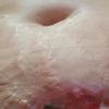 Complicaciones en la recuperación de mi abdominoplastia