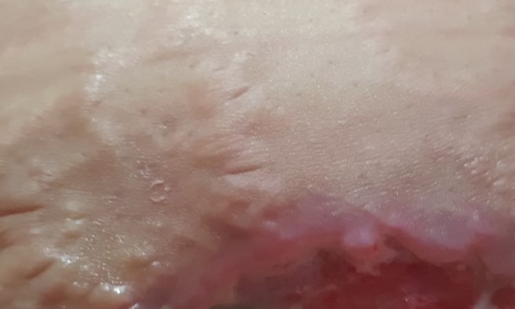 Complicaciones en la recuperación de mi abdominoplastia - 54539