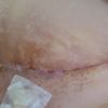 Complicaciones en la recuperación de mi abdominoplastia