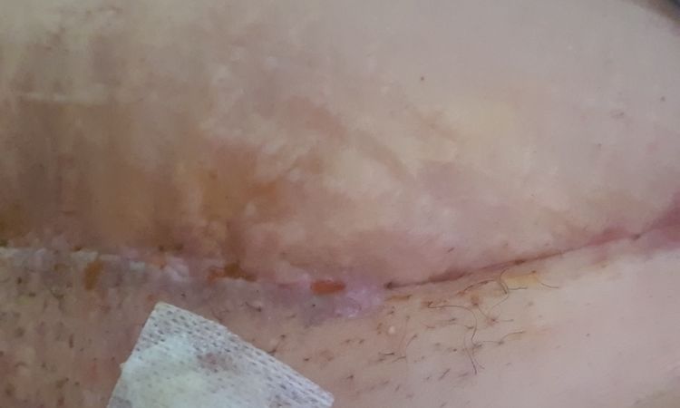 Complicaciones en la recuperación de mi abdominoplastia - 54540