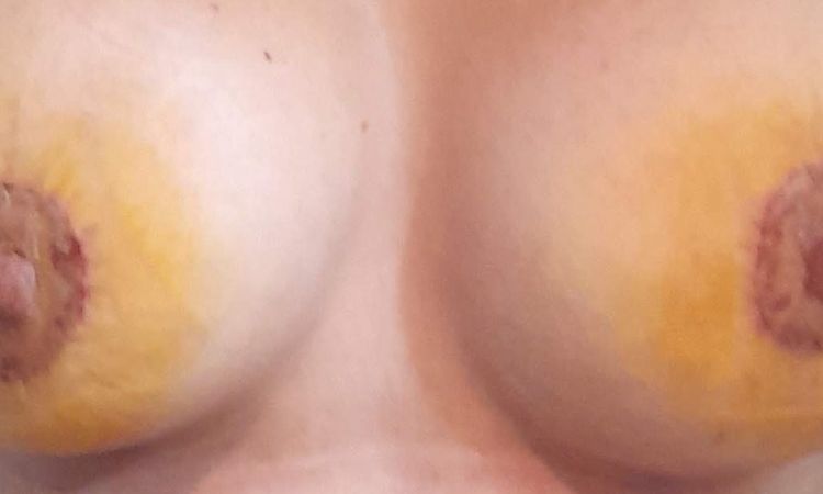 Pezones asimétricos tras segunda intervención con mastopexia periareolar. ¿Qué puedo hacer? - 54725