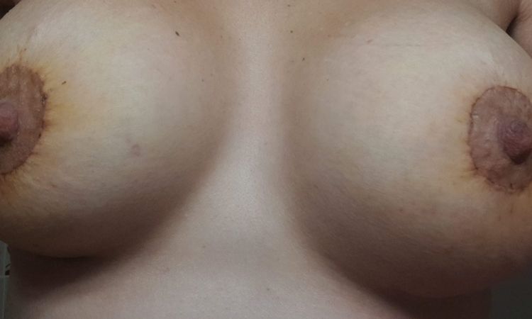 Pezones asimétricos tras segunda intervención con mastopexia periareolar. ¿Qué puedo hacer? - 54726