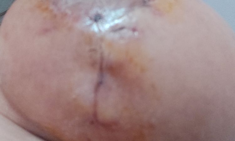 Seroma a los 15 días de mi mastopexia? - 54751