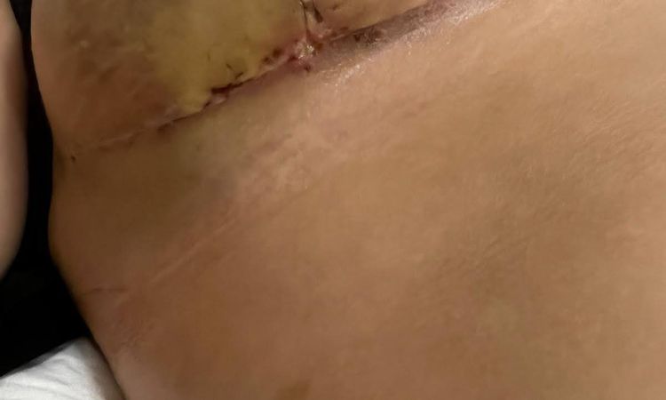 Hematomas y supuración post-quirúrgica tras mastopexia - 54761