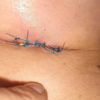 Evolución de sutura tras aumento de pecho - 54946