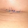 Evolución de sutura tras aumento de pecho - 54947