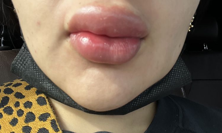 Inflamación en labios tras 4 meses de aplicación de ácido hialurónico - 55112