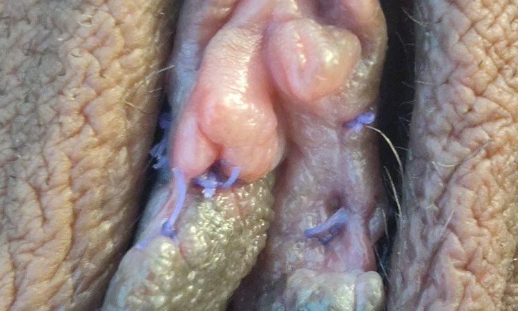 Mi cuerpo rechaza las suturas de la labioplastia - 55116