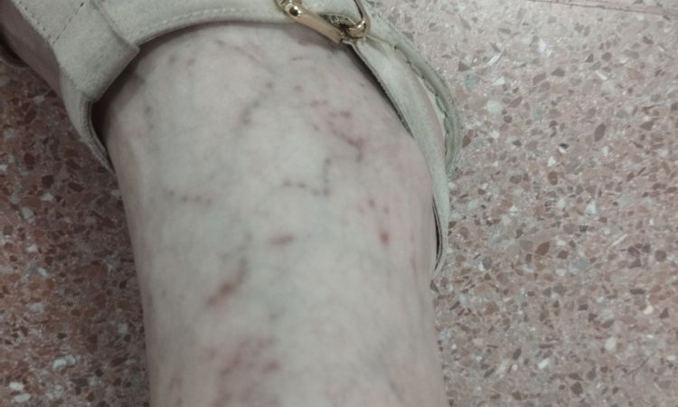 Manchas tras termo coagulación de arañas vasculares - 55202