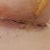 ¿Posible infección en mastopexia?