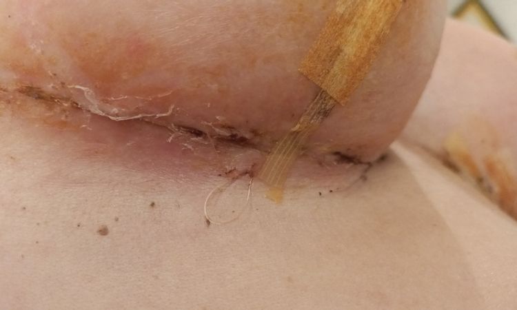 ¿Posible infección en mastopexia? - 55227