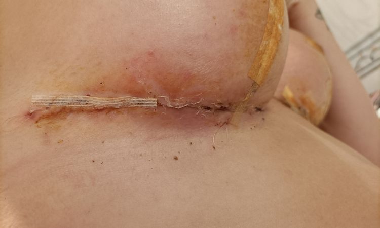 ¿Posible infección en mastopexia? - 55228