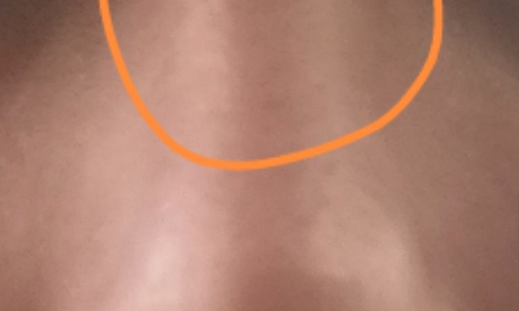 Moretón o necrosis tras rinoplastia? - 55239
