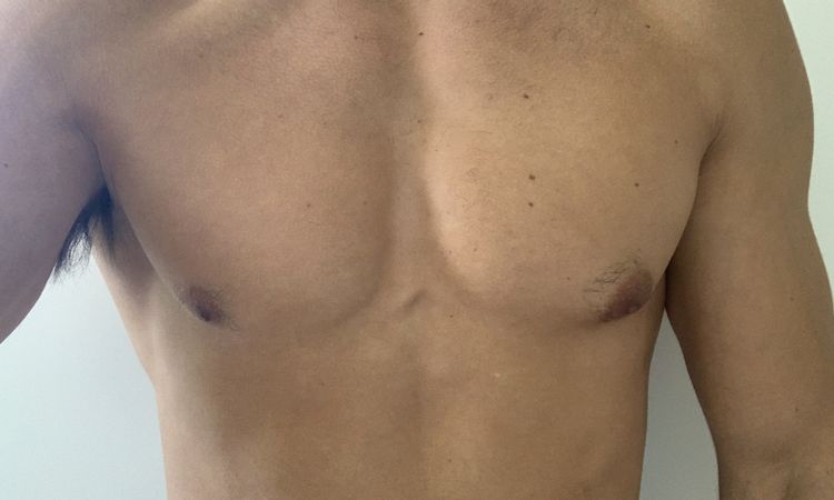 Corregir asimetría de areolas tras 7 años de ginecomastia - 55397