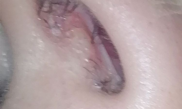 ¿Infección post rinoplastia? - 55449