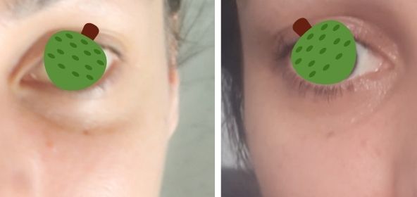 Ojo "caído" tras aplicar hialuronidasa en ojeras - 55450