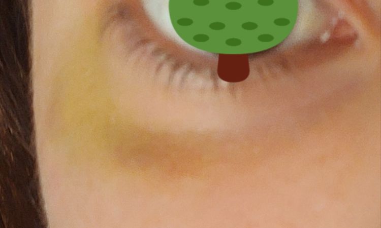 Ojo "caído" tras aplicar hialuronidasa en ojeras - 55451