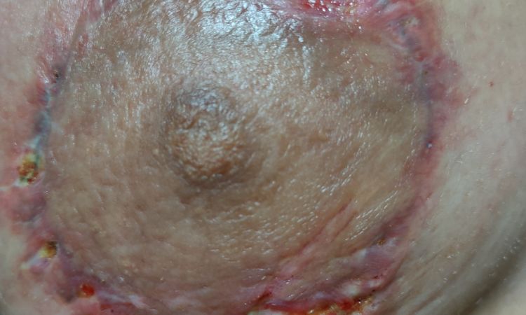 Ayudar a cerrar una herida post matopexia - 55471