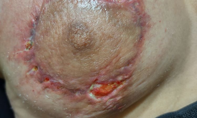 Ayudar a cerrar una herida post matopexia - 55472